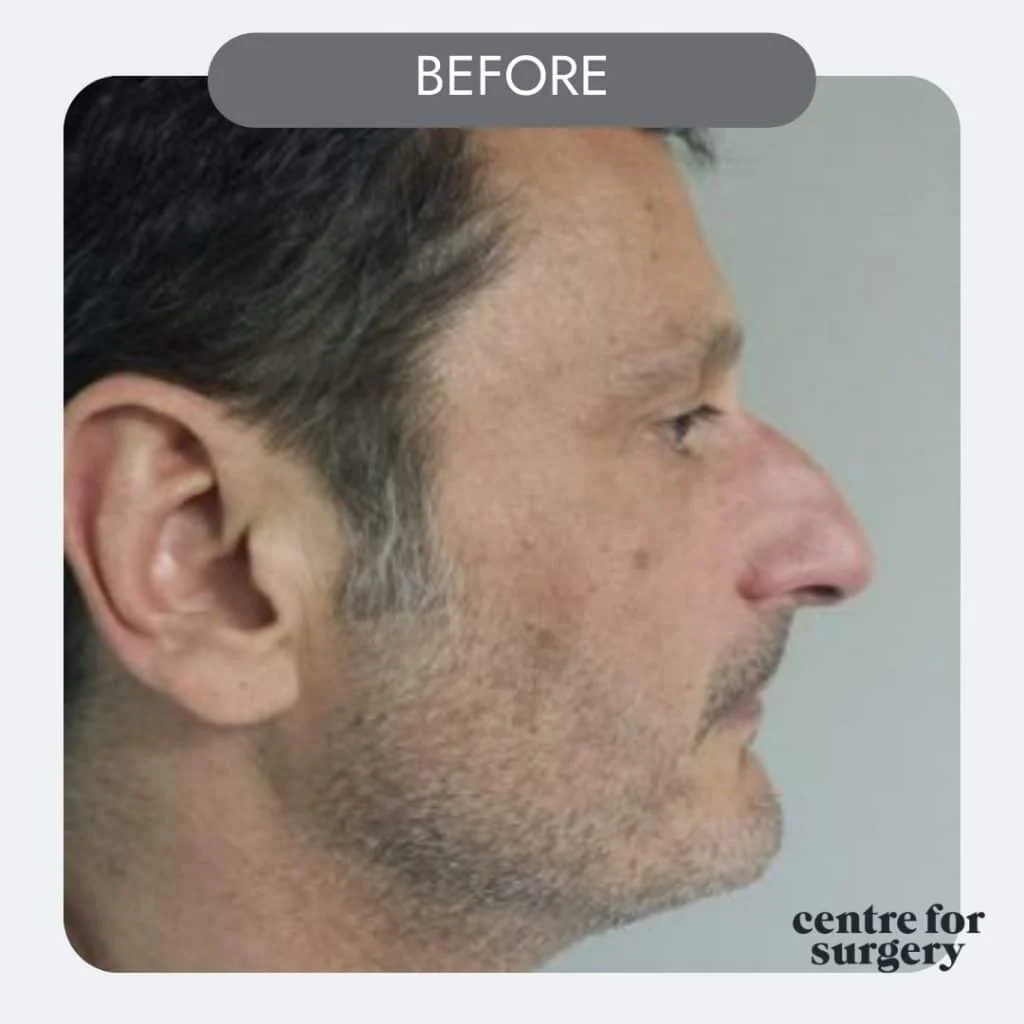 male rhinoplasty before side after profile centre for surgery uk london (1)