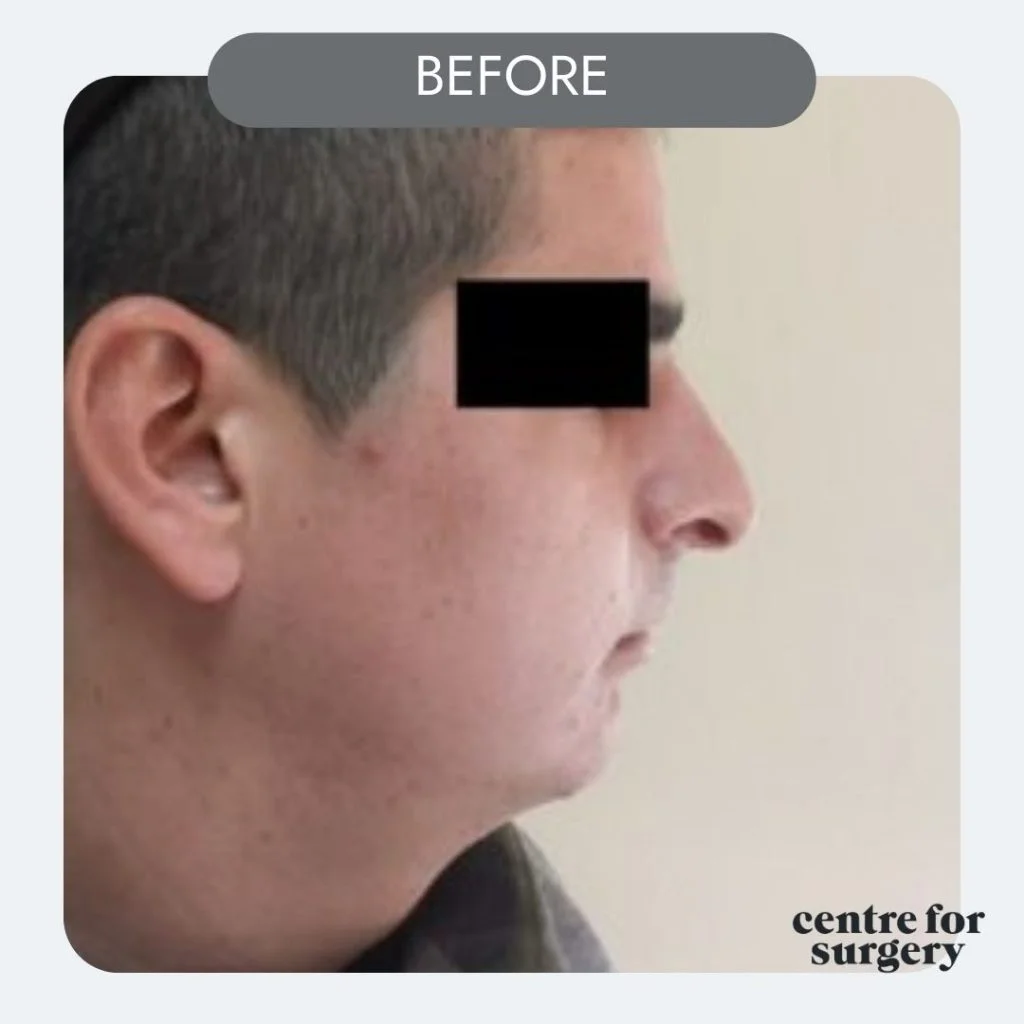 male rhinoplasty before side after profile centre for surgery uk london