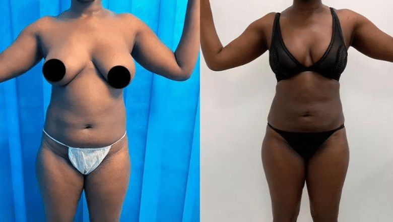 360 liposuction before and after