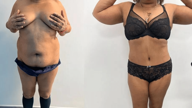 360 lipo before and after