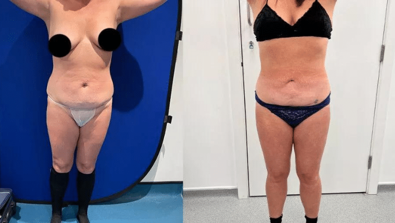 Aqua Sculpture Liposuction and Tummy Tuck Before and After