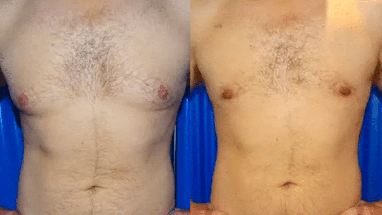 Male Breast Reduction London UK Centre for Surgery