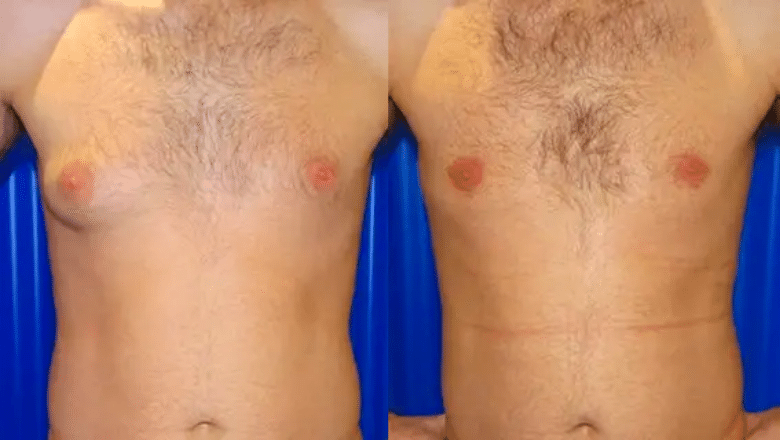 male gyno before and after