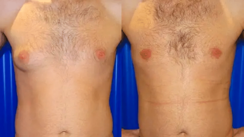 Male Breast Reduction London UK Centre for Surgery