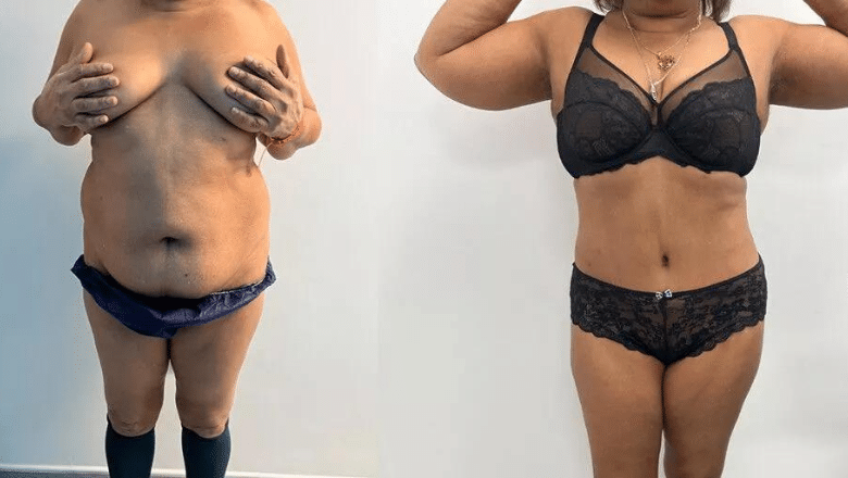 360 lipo & tummy tuck before & after