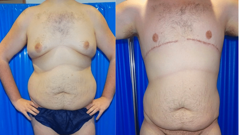 male gyno surgery before and after
