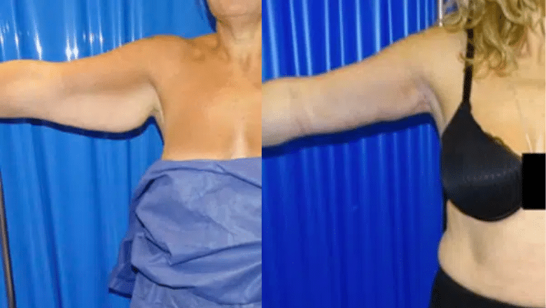 arm lift before and after