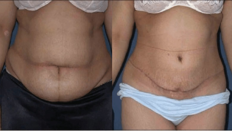 360 tummy tuck before after