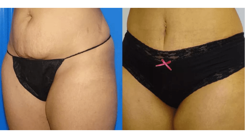 mini tummy tuck before and after