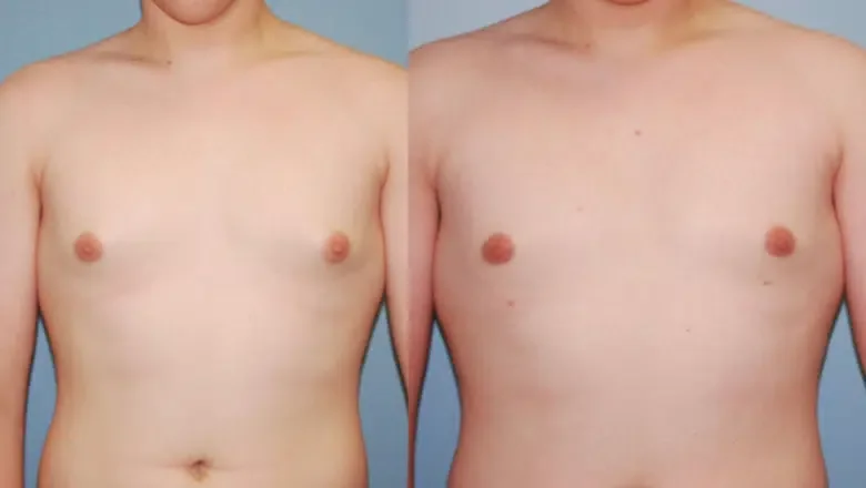 male gyno surgery before after 2