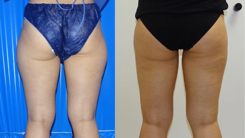 liposuction outer thighs before after 1