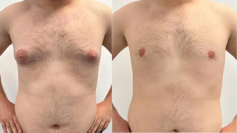 gyno surgery before after frontal view