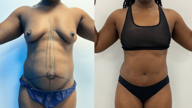 Tummy Tuck (Abdominoplasty) Before And After Photos