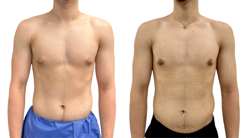 Gynecomastia Before & After, Case 10