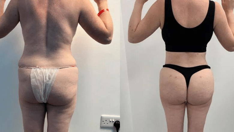 Brazilian Butt Lift (BBL) Before & After Photos