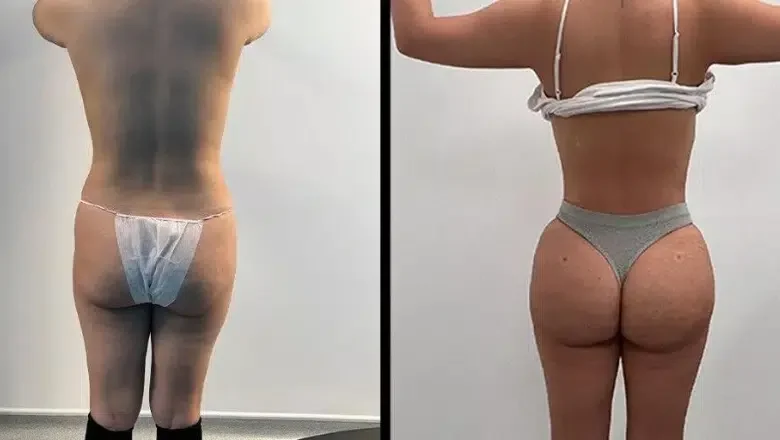 360 Lipo & BBL before and after