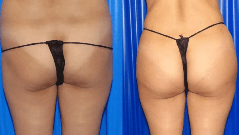 IS A BRAZILIAN BUTT LIFT OR BUTT IMPLANTS RIGHT FOR ME? - Evolve