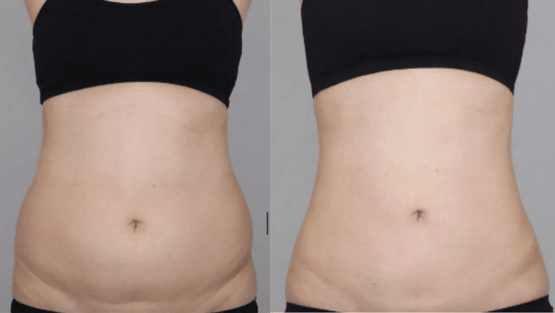 stomach liposuction before and after