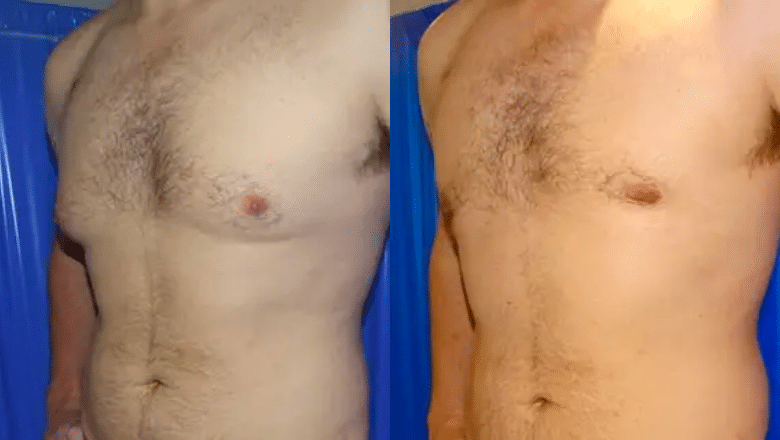 Male Breast Reduction London UK Centre for Surgery