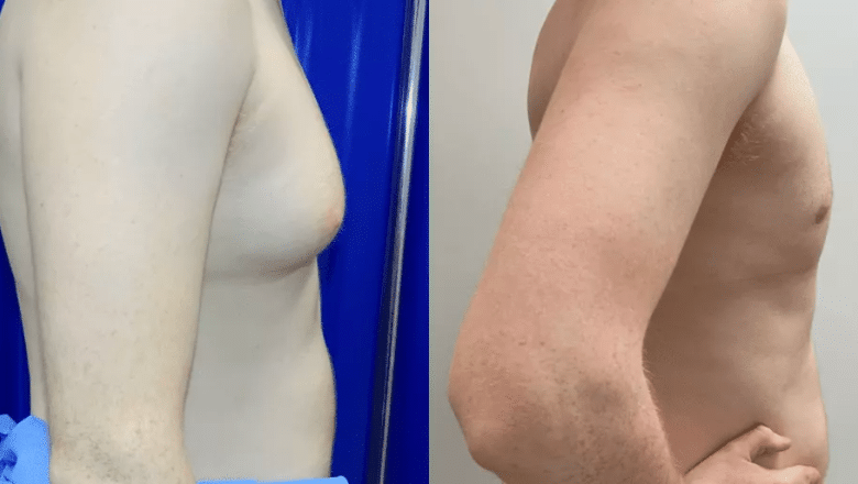 How to Get Rid of Man Boobs or Gynecomastia - InsideHook