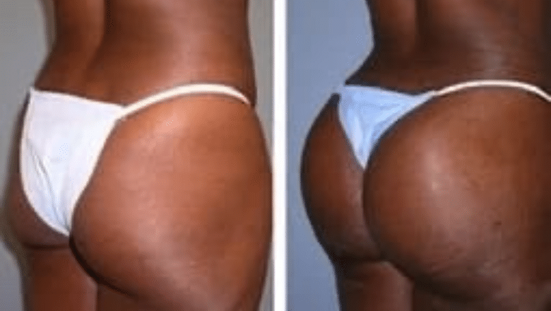 Patient 8522196, Brazilian Butt Lift (BBL) Before & After Photos