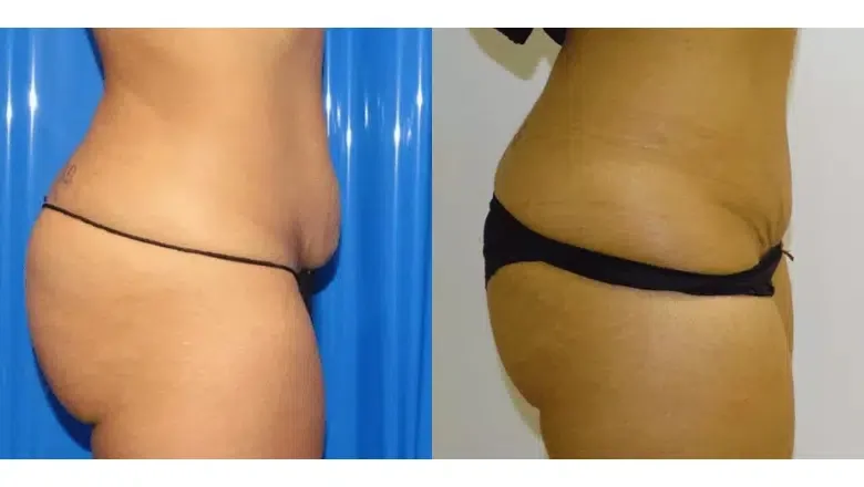 mini tummy tuck before and after