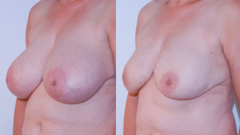 liposuction breast reduction before after 2