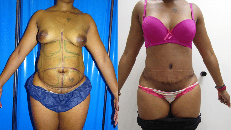 tummy tuck hernia repair before after