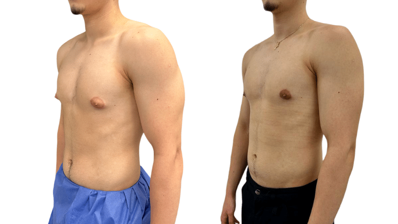 Gynecomastia vs Fat - How to Tell the Difference