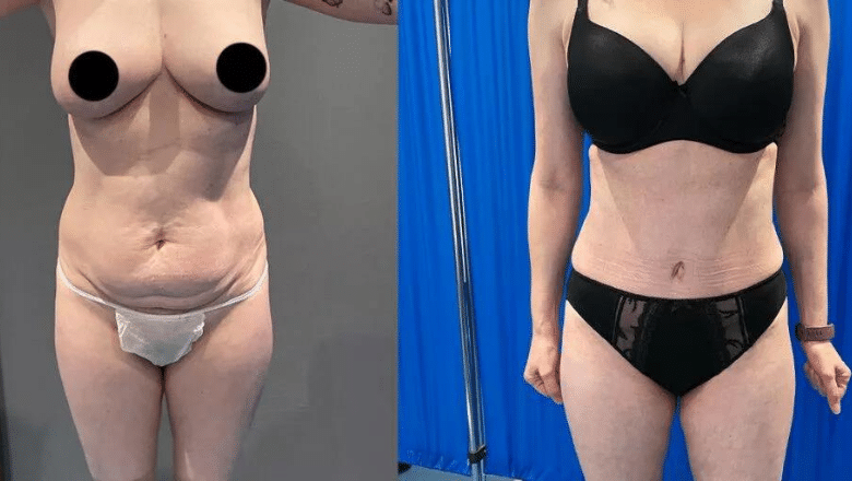 360 lipo & tummy tuck before and after
