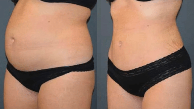 360 liposuction before and after