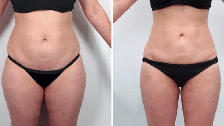abdominal liposuction before and after