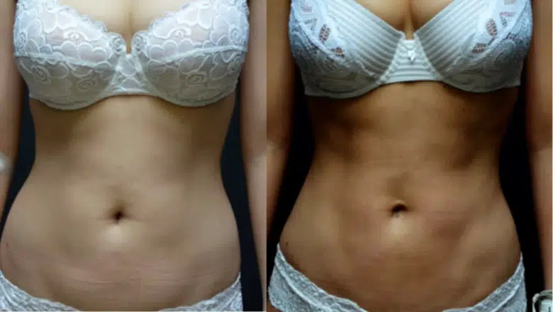 tummy liposuction before and after 