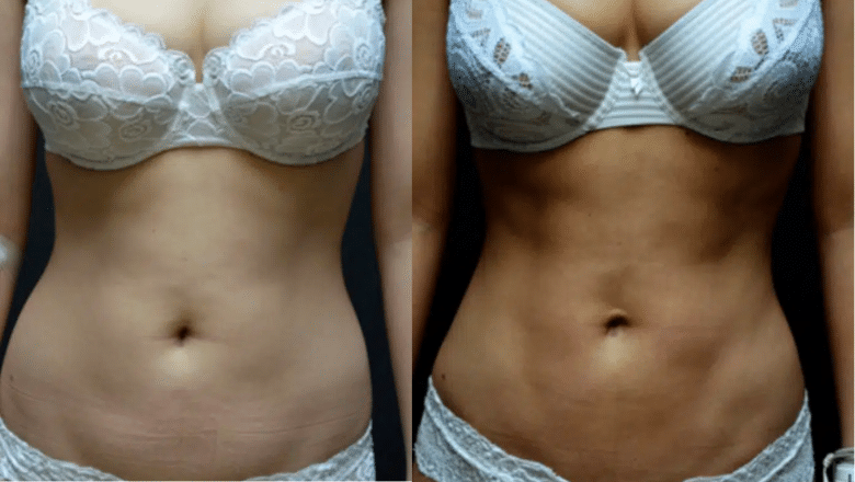 tummy liposuction before and after 