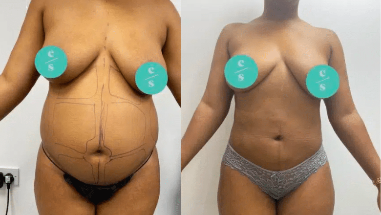 belly liposuction before and after 