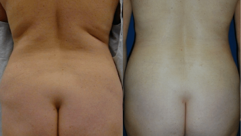 back liposuction before and after