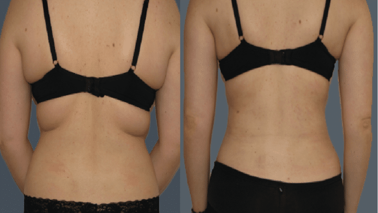 back bra roll liposuction before and after 3