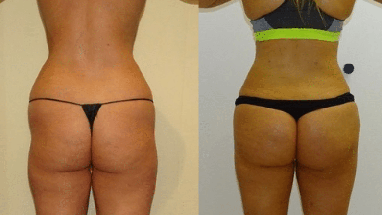 Brazilian Butt Lift (BBL) Before & After Photos