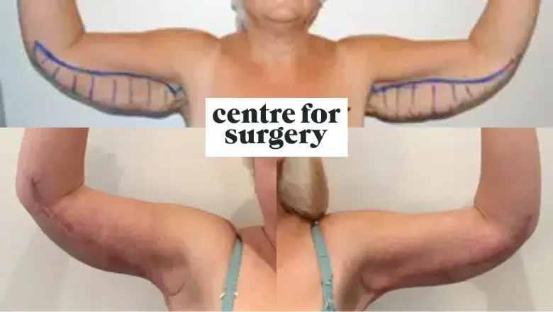 brachioplasty before and after results 