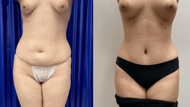 brazilian abdominoplasty before and after