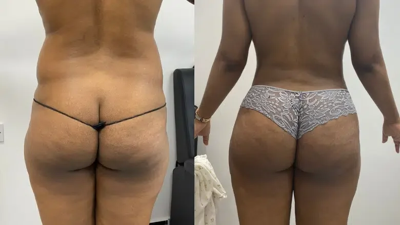 brazilian butt lift before after