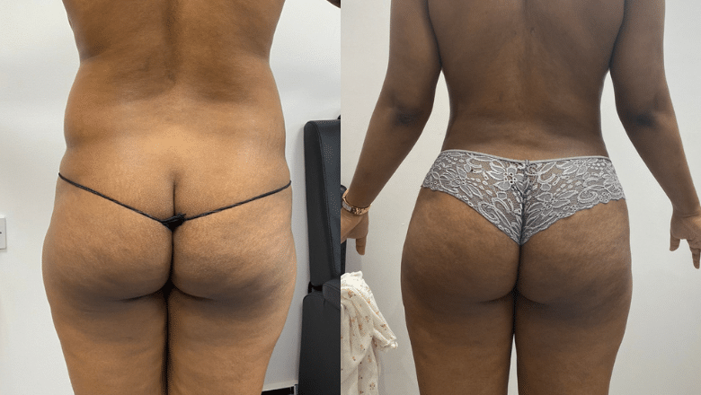 Brazilian Butt Lift Results