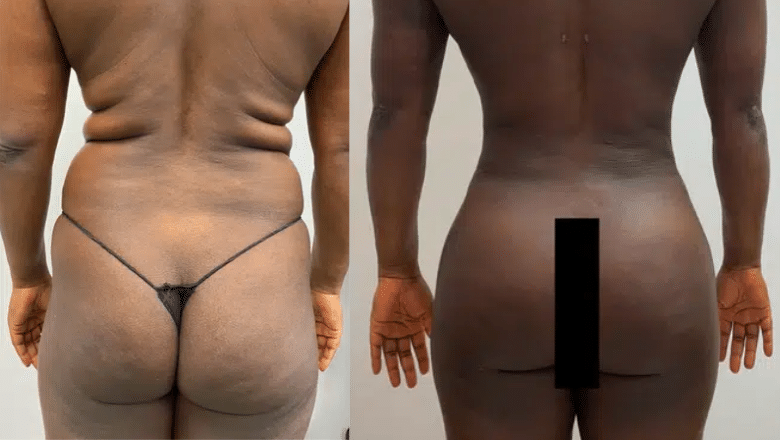 Brazilian Butt Lift (BBL) Before & After Photos