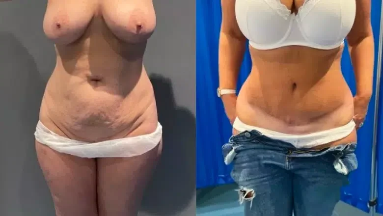 Tummy tuck before and after