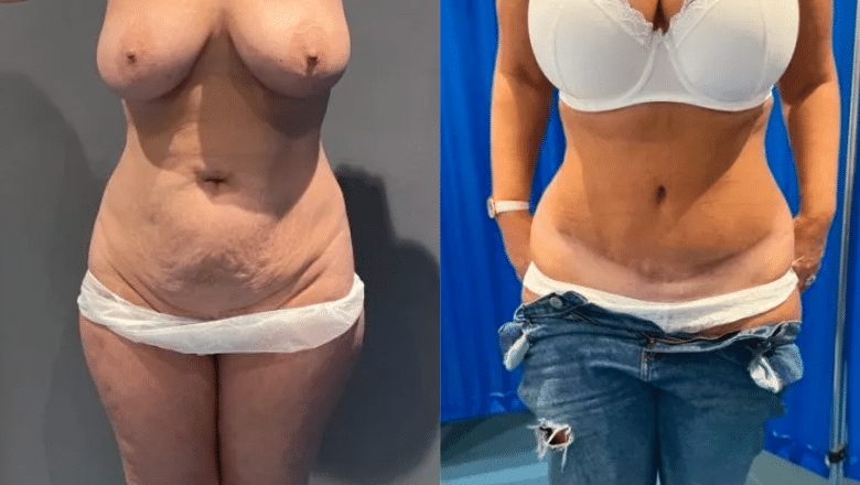 Tummy tuck before and after following the proper diet