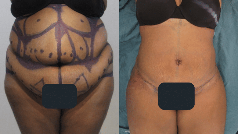 brazilian tummy tuck before and after