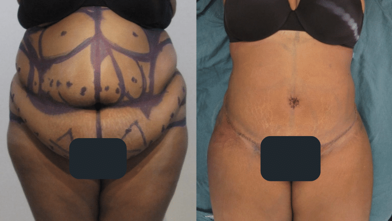Reverse Tummy Tuck - Understanding Its Techniques and Benefits