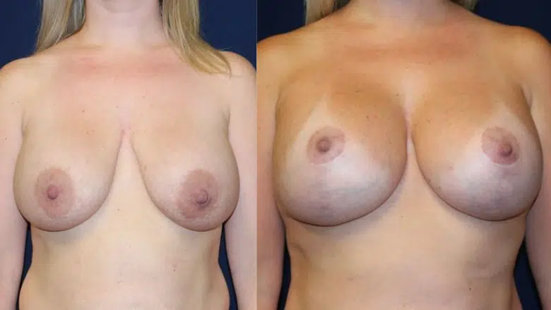 breast-lift-before-after-7.png.webp?format=webp&amp;nv=212368fc-2000-40d1-9026-c0f94abda644