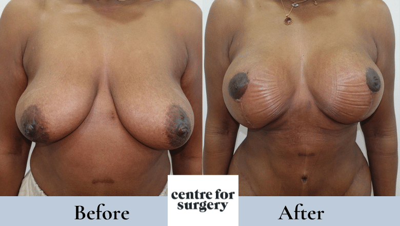 breast lift with implants before and after 3