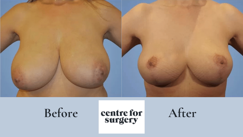 breast reduction surgery before after
